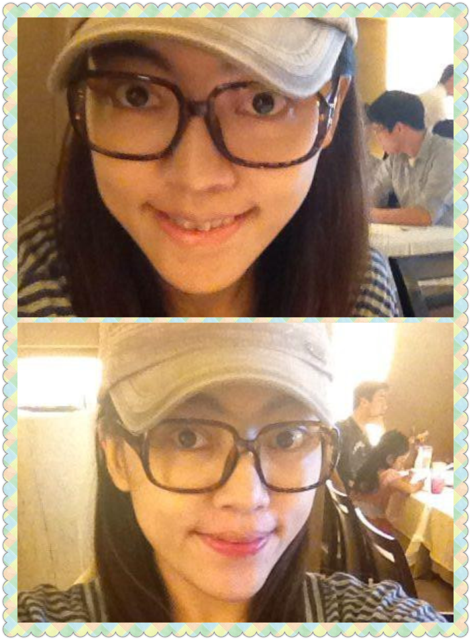 星采大安_雙眼皮_邱大睿院長06 星采大安_雙眼皮_邱大睿院長06