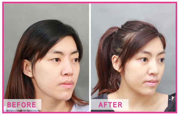 星采大安_雙眼皮_邱大睿院長08 星采大安_雙眼皮_邱大睿院長08