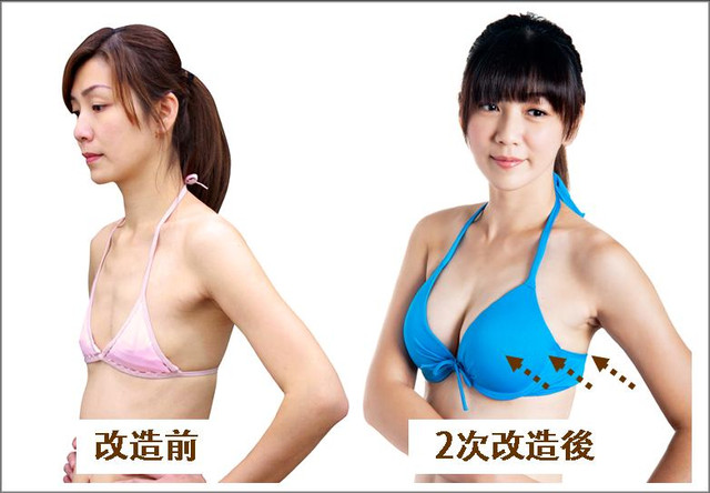 星采大安_自體脂肪胸部填補_邱大睿院長01 星采大安_自體脂肪胸部填補_邱大睿院長01