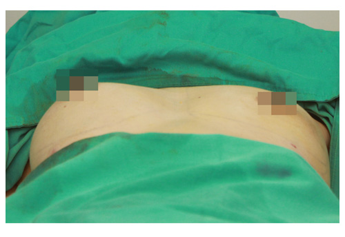 星采大安_自體脂肪胸部填補_邱大睿院長16 星采大安_自體脂肪胸部填補_邱大睿院長16