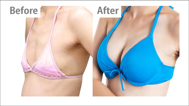 星采大安_自體脂肪胸部填補_邱大睿院長18 星采大安_自體脂肪胸部填補_邱大睿院長18