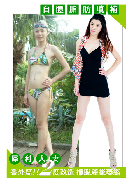 星采大安_自體脂肪胸部填補_邱大睿院長22 星采大安_自體脂肪胸部填補_邱大睿院長22