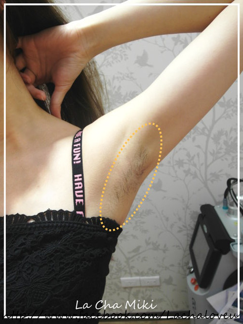 星和高雄_雷射除毛_米粒02 星和高雄_雷射除毛_米粒02