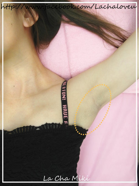 星和高雄_雷射除毛_米粒04 星和高雄_雷射除毛_米粒04