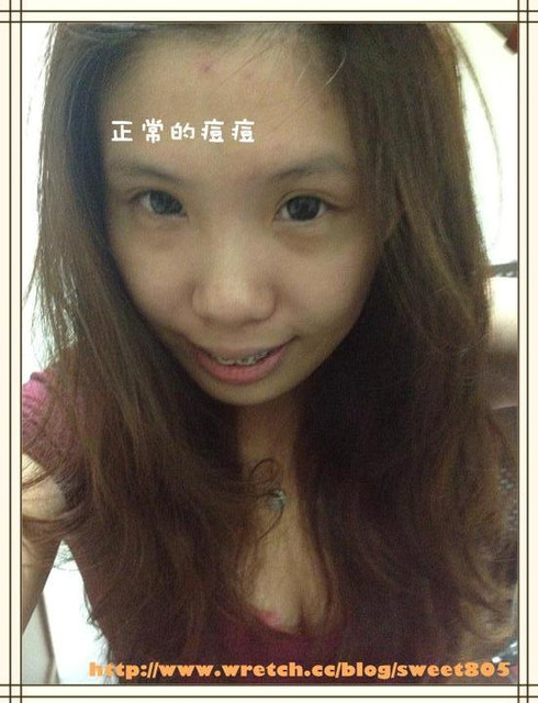 高雄醫美星和診所_杏仁酸煥膚12 高雄醫美星和診所_杏仁酸煥膚12
