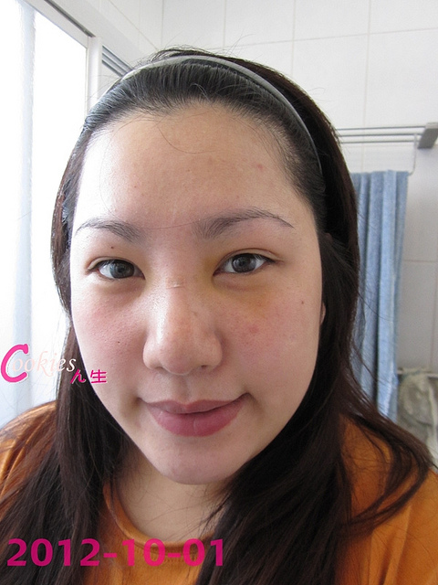 星和台北_韓式隆鼻/三段式隆鼻_邱大睿醫師04 星和台北_韓式隆鼻/三段式隆鼻_邱大睿醫師04