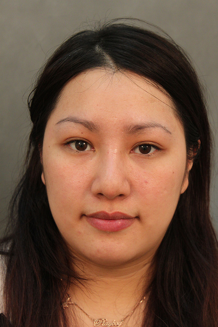 星和台北_韓式隆鼻/三段式隆鼻_邱大睿醫師07 星和台北_韓式隆鼻/三段式隆鼻_邱大睿醫師07