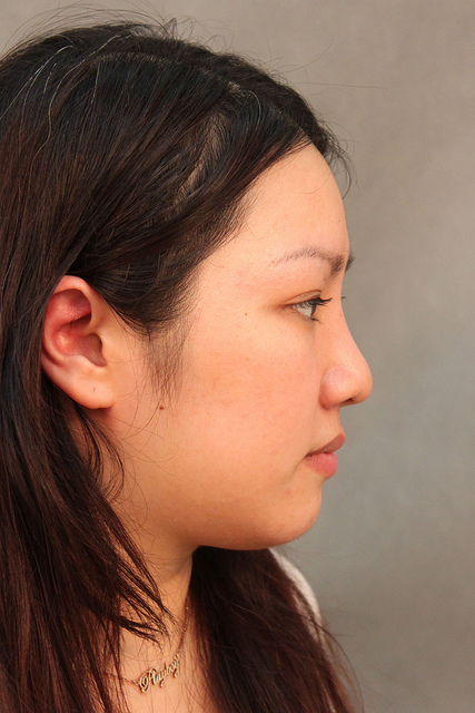 星和台北_韓式隆鼻/三段式隆鼻_邱大睿醫師09 星和台北_韓式隆鼻/三段式隆鼻_邱大睿醫師09