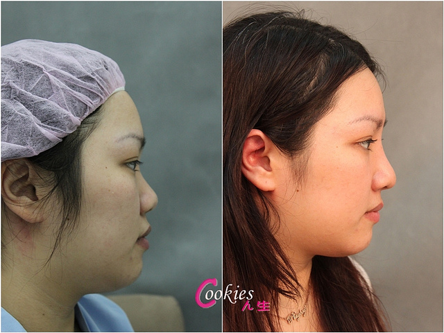星和台北_韓式隆鼻/三段式隆鼻_邱大睿醫師23 星和台北_韓式隆鼻/三段式隆鼻_邱大睿醫師23