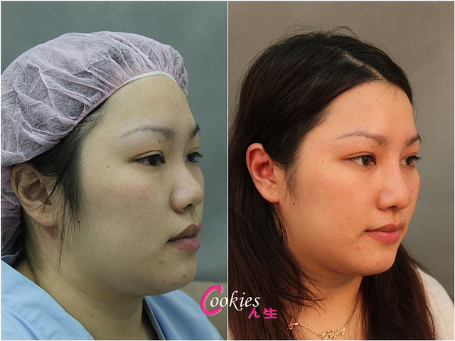 星和台北_韓式隆鼻/三段式隆鼻_邱大睿醫師24 星和台北_韓式隆鼻/三段式隆鼻_邱大睿醫師24