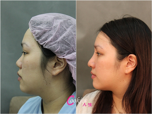 星和台北_韓式隆鼻/三段式隆鼻_邱大睿醫師26 星和台北_韓式隆鼻/三段式隆鼻_邱大睿醫師26