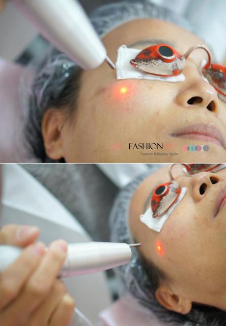 星和台北_雙眼皮_杞孟衿醫師07 星和台北_雙眼皮_杞孟衿醫師07