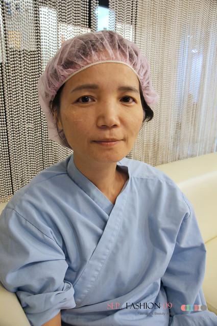 星和台北_雙眼皮_杞孟衿醫師14 星和台北_雙眼皮_杞孟衿醫師14