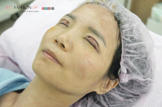 星和台北_雙眼皮_杞孟衿醫師18 星和台北_雙眼皮_杞孟衿醫師18