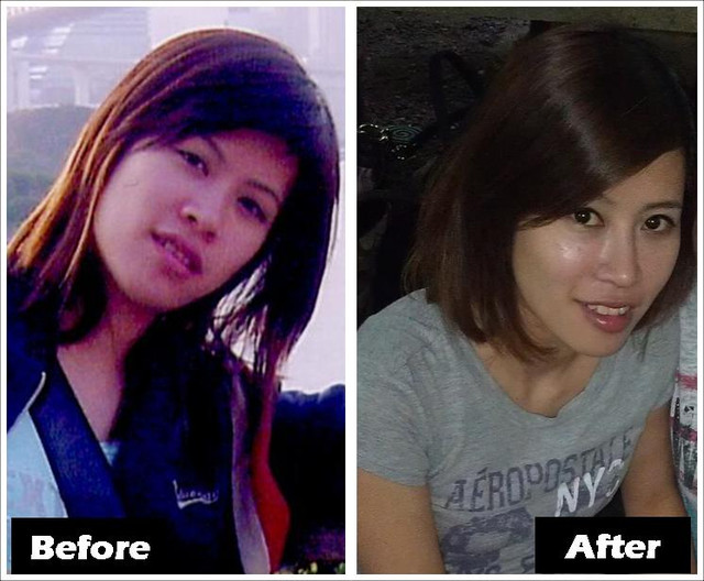 星采大安_韓式隆鼻/三段式隆鼻_邱大睿醫師09 星采大安_韓式隆鼻/三段式隆鼻_邱大睿醫師09