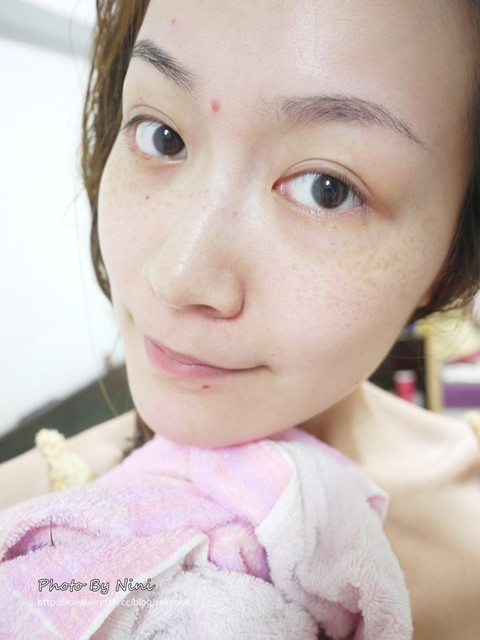 星和台中_雷射除痣_Nini26 星和台中_雷射除痣_Nini26