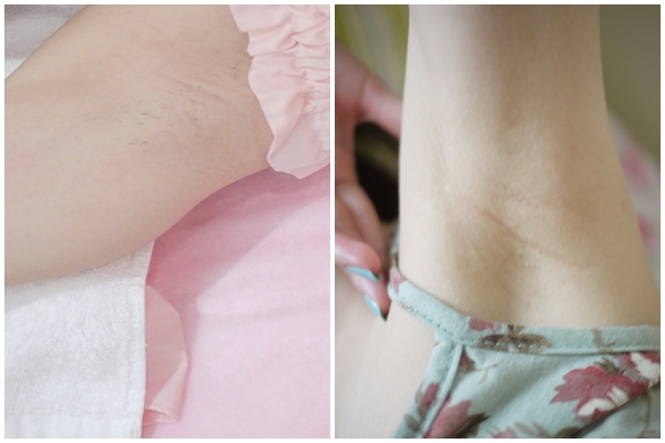 星和台中_雷射除毛_曉琪拉19 星和台中_雷射除毛_曉琪拉19