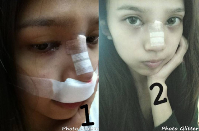 星和台北_韓式隆鼻.開眼頭_邱大睿醫師10 星和台北_韓式隆鼻.開眼頭_邱大睿醫師10