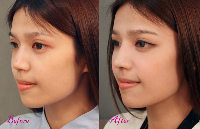 星和台北_韓式隆鼻.開眼頭_邱大睿醫師16 星和台北_韓式隆鼻.開眼頭_邱大睿醫師16