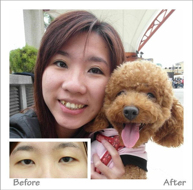 星和台北_雙眼皮_杞孟衿醫師01 星和台北_雙眼皮_杞孟衿醫師01