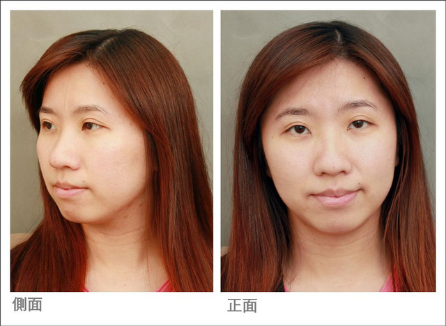 星和台北_雙眼皮_杞孟衿醫師10 星和台北_雙眼皮_杞孟衿醫師10