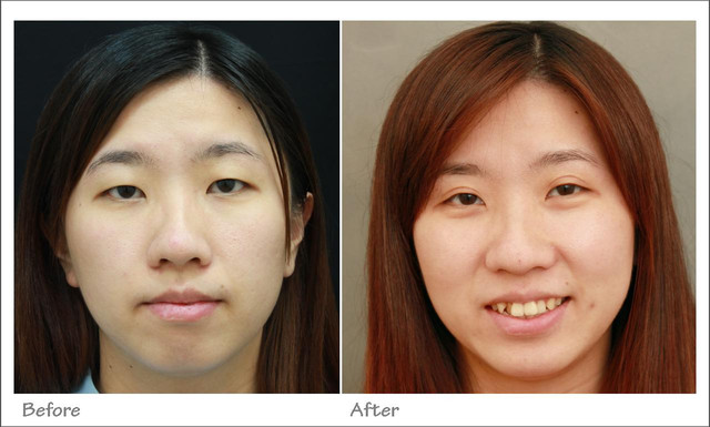 星和台北_雙眼皮_杞孟衿醫師11 星和台北_雙眼皮_杞孟衿醫師11