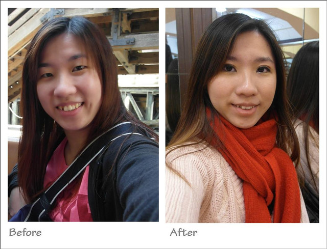 星和台北_雙眼皮_杞孟衿醫師12 星和台北_雙眼皮_杞孟衿醫師12