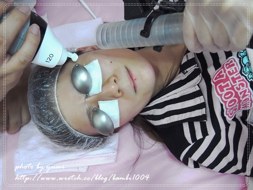 星和台北_雷射除痣_娃娃09 星和台北_雷射除痣_娃娃09