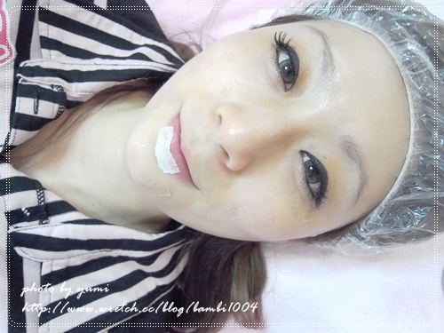 星和台北_雷射除痣_娃娃12 星和台北_雷射除痣_娃娃12