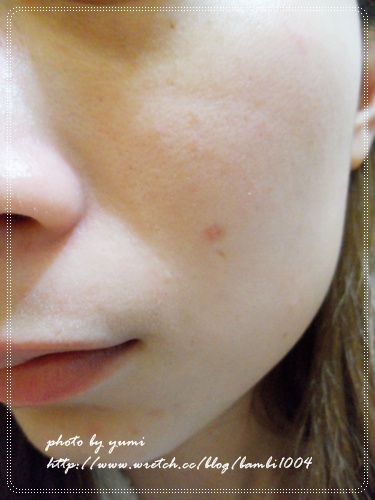 星和台北_雷射除痣_娃娃17 星和台北_雷射除痣_娃娃17