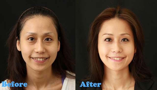 星采醫美_眼袋淚溝填平_杞孟衿醫師08 星采醫美_眼袋淚溝填平_杞孟衿醫師08