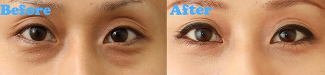 星采醫美_眼袋淚溝填平_杞孟衿醫師09 星采醫美_眼袋淚溝填平_杞孟衿醫師09