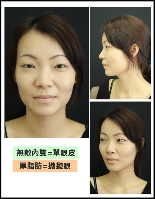 星和醫美_雙眼皮_杞孟衿醫師05 星和醫美_雙眼皮_杞孟衿醫師05