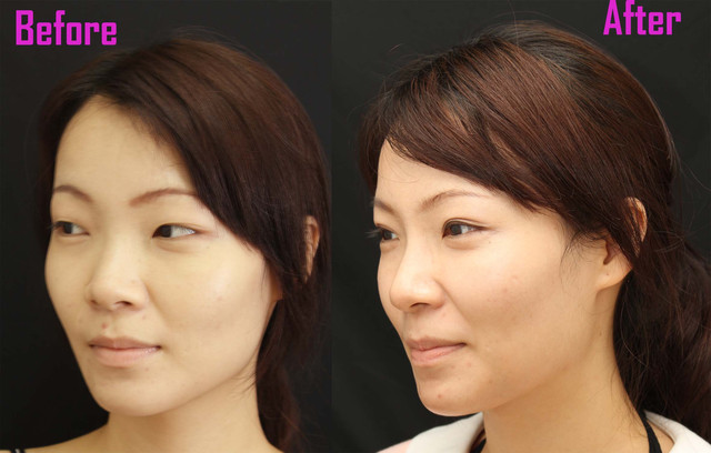 星和醫美_雙眼皮_杞孟衿醫師09 星和醫美_雙眼皮_杞孟衿醫師09