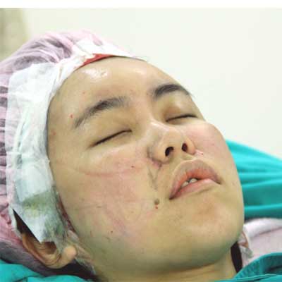 星和台北_自體脂肪填補_COCO17 星和台北_自體脂肪填補_COCO17