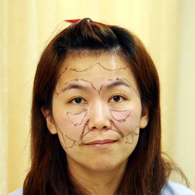 星和台北_自體脂肪填補_COCO20 星和台北_自體脂肪填補_COCO20