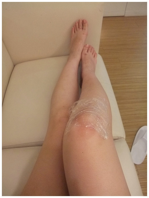 星和醫美_亞歷山大除毛08 星和醫美_亞歷山大除毛08