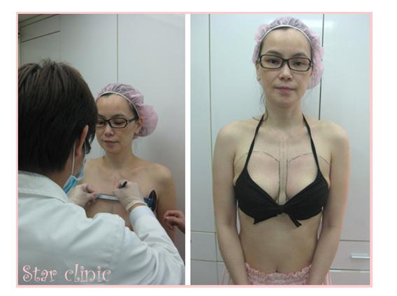 星采星和_果凍隆乳05 星采星和_果凍隆乳05