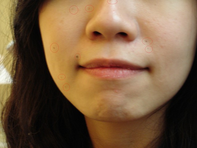 星采古亭_雷射除痣_哈哈05 星采古亭_雷射除痣_哈哈05