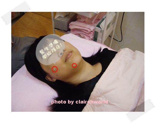 星采古亭_雷射除痣_Claireh14 星采古亭_雷射除痣_Claireh14
