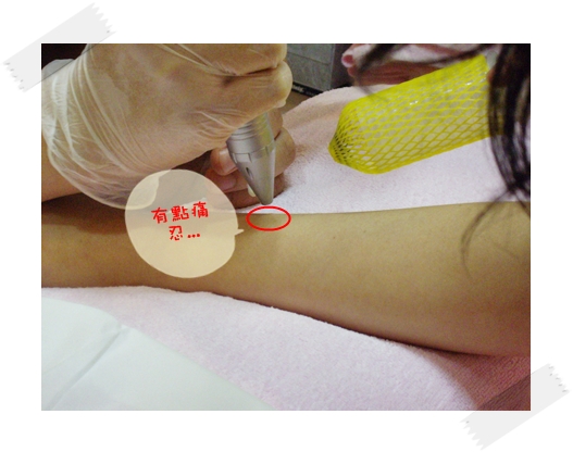 星采古亭_雷射除痣_Claireh18 星采古亭_雷射除痣_Claireh18