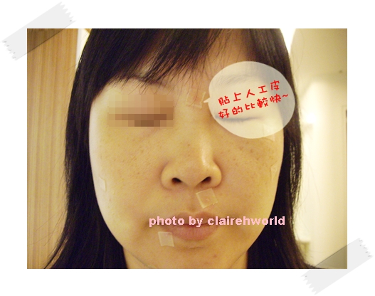 星采古亭_雷射除痣_Claireh20 星采古亭_雷射除痣_Claireh20