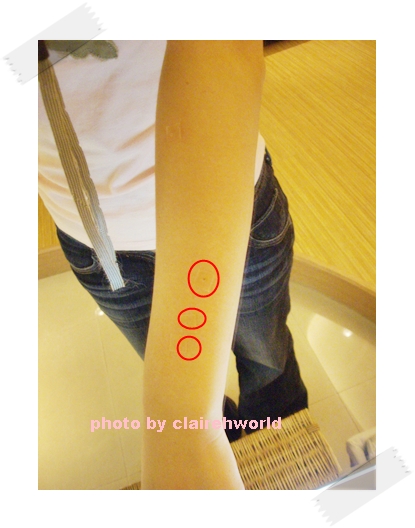 星采古亭_雷射除痣_Claireh21 星采古亭_雷射除痣_Claireh21