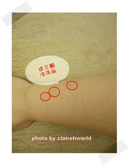 星采古亭_雷射除痣_Claireh23 星采古亭_雷射除痣_Claireh23