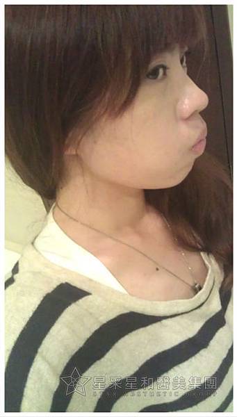 星采大安_櫻花染料雷射_淑鈴11 星采大安_櫻花染料雷射_淑鈴11