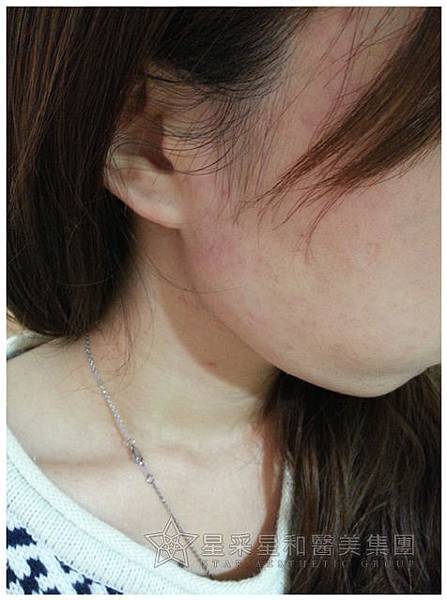 星采大安_櫻花染料雷射_淑鈴08 星采大安_櫻花染料雷射_淑鈴08