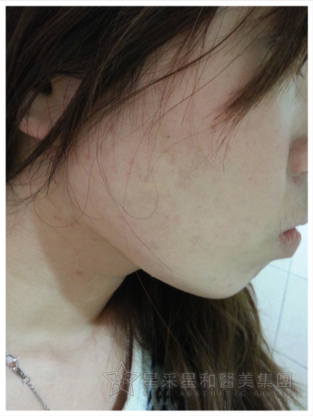 星采大安_櫻花染料雷射_淑鈴07 星采大安_櫻花染料雷射_淑鈴07