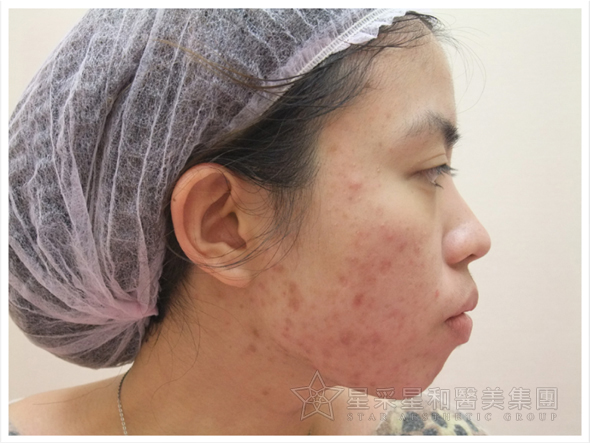 星采大安_櫻花染料雷射_淑鈴06 星采大安_櫻花染料雷射_淑鈴06