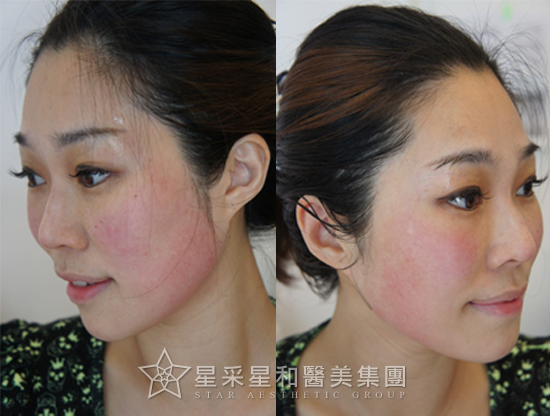 星采古亭_電波拉皮_黑松露12 星采古亭_電波拉皮_黑松露12