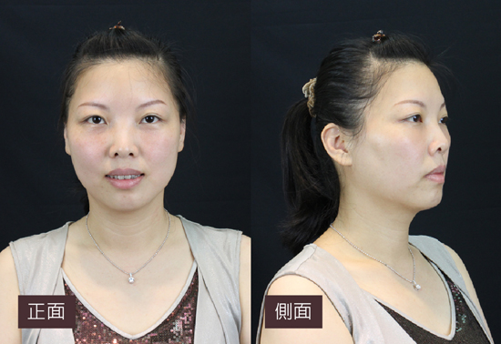 星采大安_眼袋淚溝填平_邱大睿院長14 星采大安_眼袋淚溝填平_邱大睿院長14